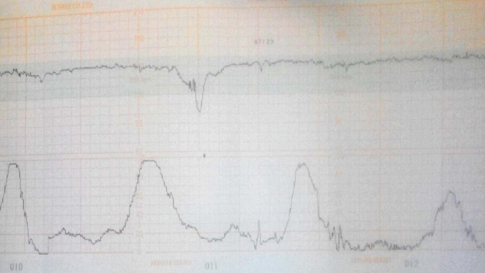 病例9 變異減速